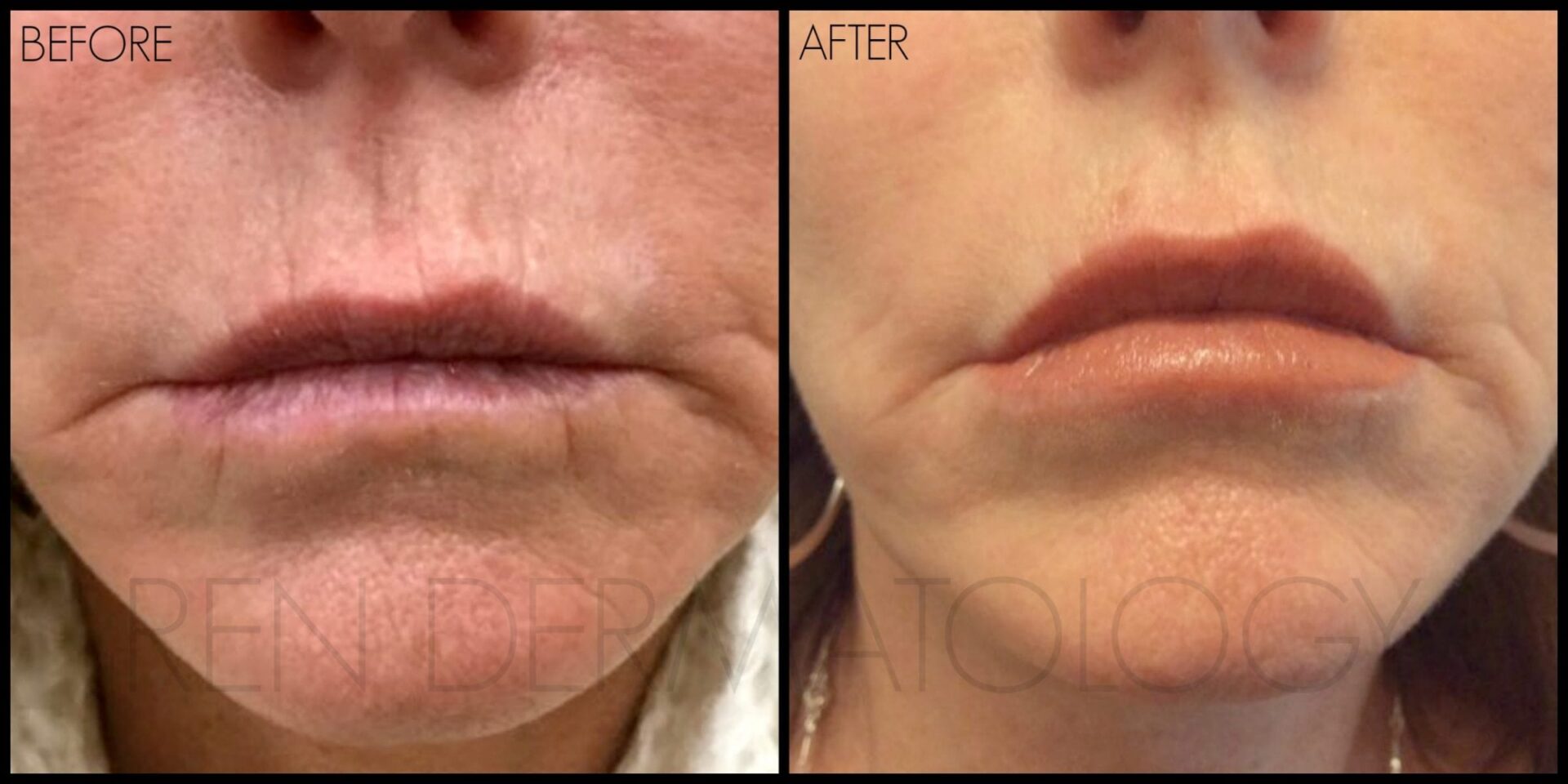 Are natural-looking lip injections possible? YES! - REN Dermatology ...