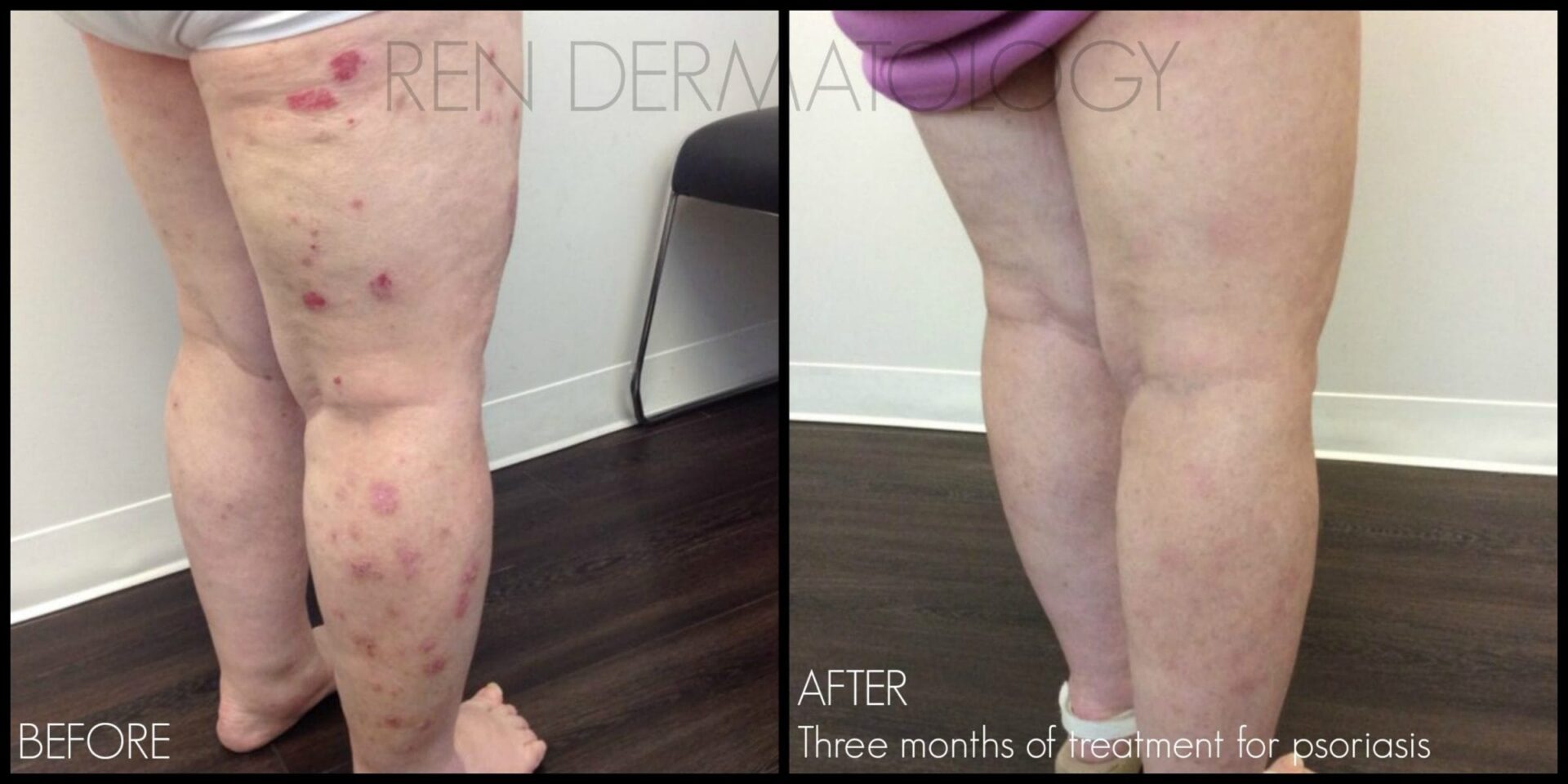 before and after laser treatment for psoriasis