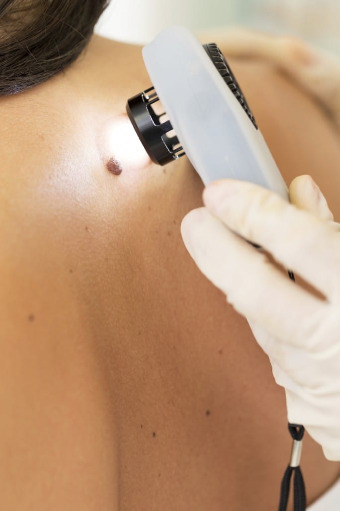 skin cancer laser treatment