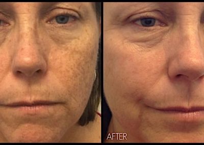 After one treatment of IPL (Elos Plus SRA), Note improvement of freckles and sun damage. Improved complexion.