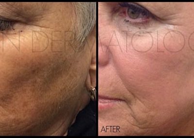 improvement of texture, brown spots, and wrinkles after one treatment of Co2RE Laser.