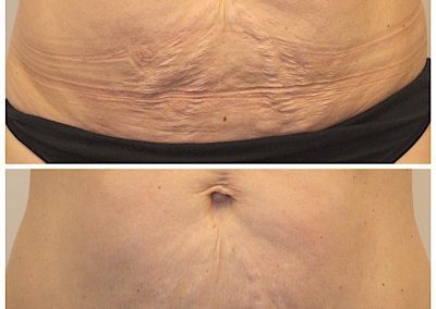 UltraShape Power and VelaShape: treating unwanted abdominal fat and tightening loose abdominal skin