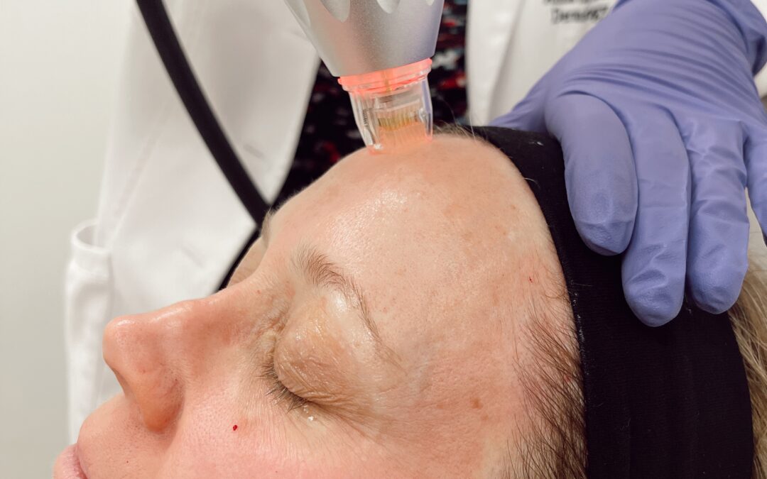 microneedling with radio frequency