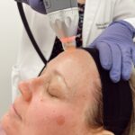 microneedling with radio frequency
