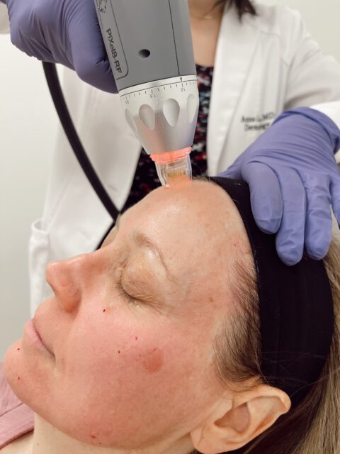 PiXel8-RF- Microneedling With Radio Frequency - REN Dermatology ...