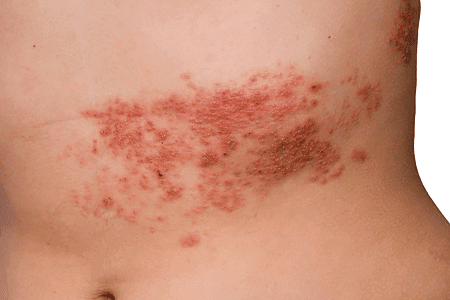 4 Facts You May Not Know About Shingles