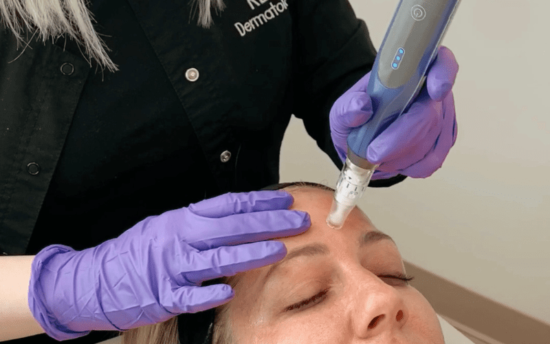 The Ultimate Guide to Post-Microneedling Treatment - REN Dermatology 