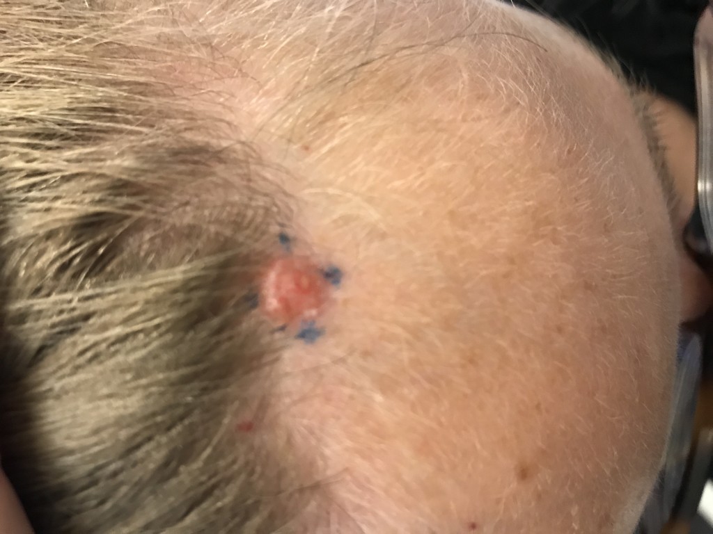 7 Facts You May Not Know About Basal Cell Carcinoma • Ren Dermatology