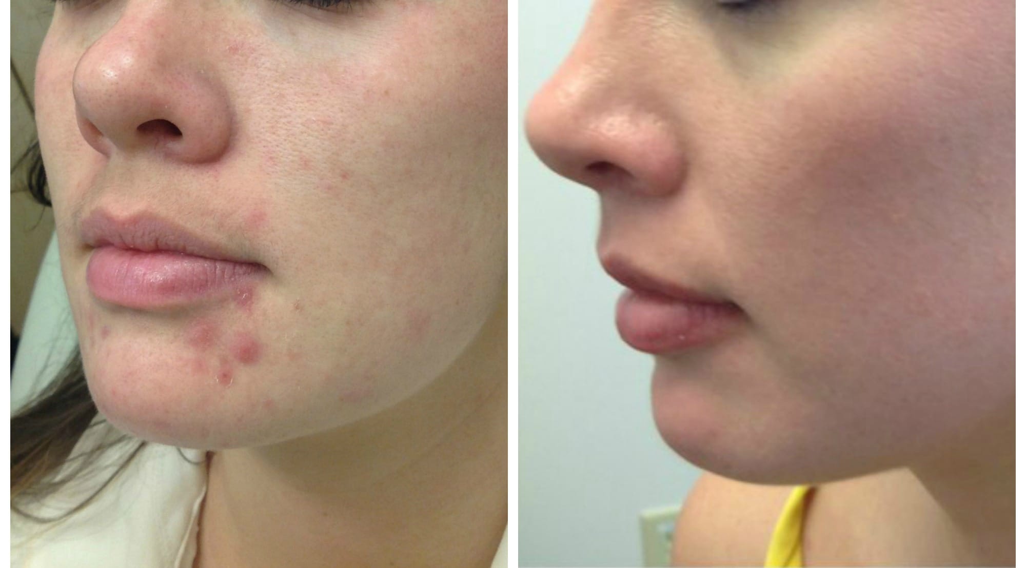 A Real Patient’s Experience With Isotretinoin
