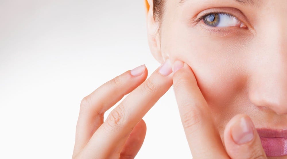 Are You Affected By Acne? {Research Study}