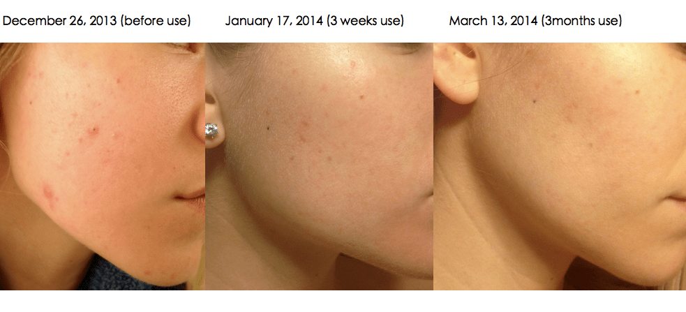 Transformation Thursday :: Clarisonic