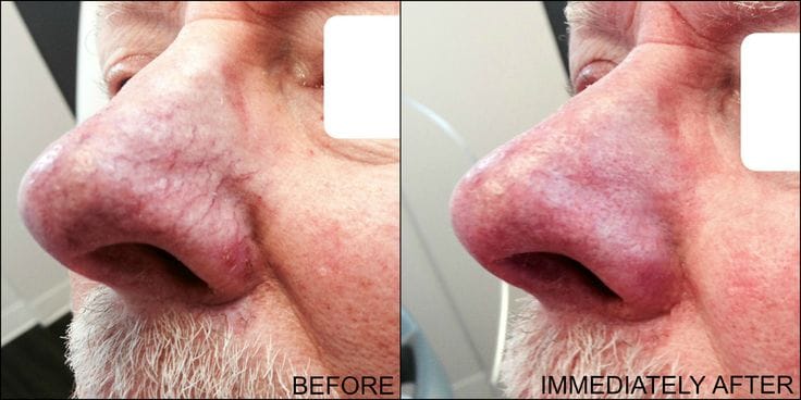 Product Spotlight: Quanta Light 4V Laser