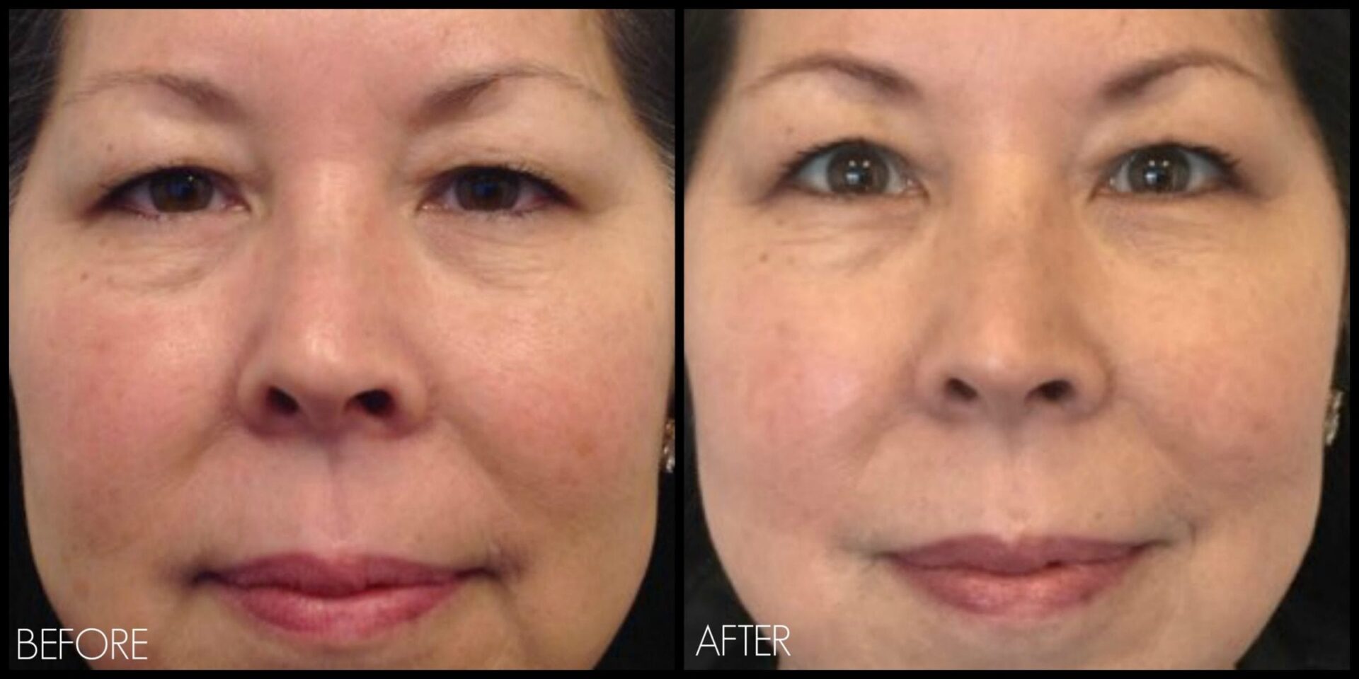 Ultherapy Eye Special: The Treatment You’ve Been Waiting For!