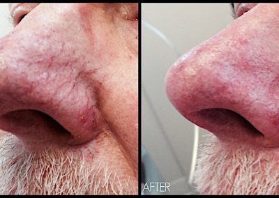 Improvement of dilated capillaries on nose and cheek with Quanta Laser