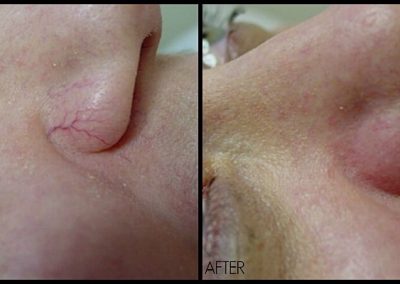 Improved dilated capillaries at corners of nose