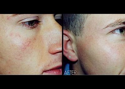 Improvement of broken capillaries at cheeks