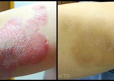 Pharos Excimer laser results after treatment for psoriasis
