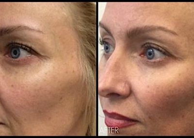 Three months after Ultherapy treatment to full face. Improvement of lines and wrinkles around mouth (no fillers used).