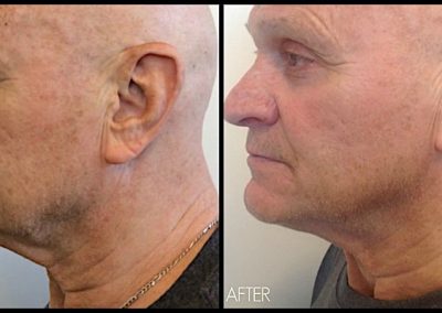Four months after Ultherapy treatment to full face and neck. Improvement of sagging skin along jawline and “turkey neck.”