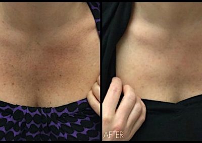 Improvement of freckles and discoloration at chest with Elos Plus SRA (IPL) treatment
