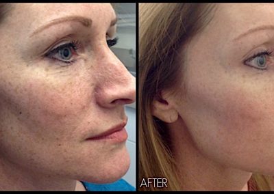 IPL laser treatment: Improving freckles and sun damage
