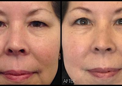 Brow lift and opening of eyes, 3 months after Ultherapy treatment.