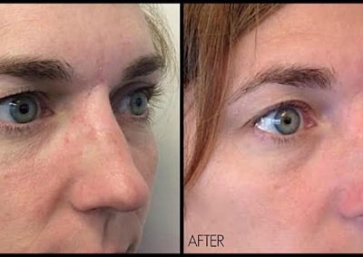 Notice lifting of eyebrow and improvement of upper eyelid heaviness after one treatment of Ultherapy.
