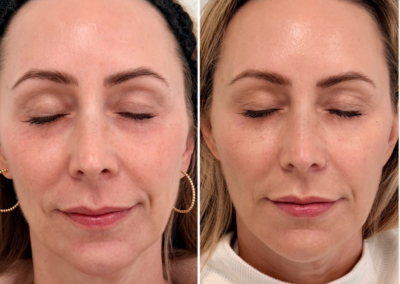 Full Facial Balancing at REN Dermatology