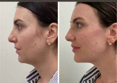 Lower face balancing with filler at REN Dermatology