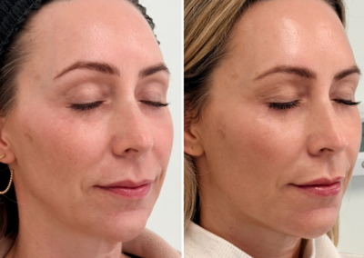 Full face filler at REN Dermatology