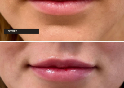 Lip filler at REN Dermatology