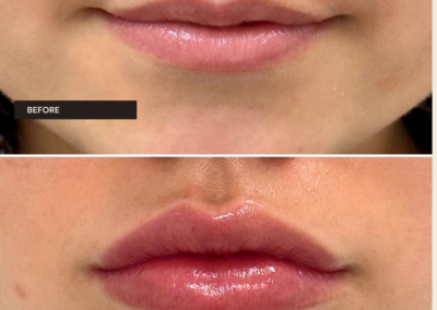 Lip filler at REN Dermatology
