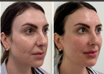 Lower face filler at REN Dermatology