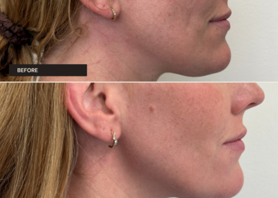 Jawline filler at REN Dermatology