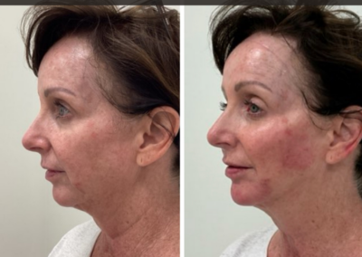 Lower face cosmetic filler at REN Dermatology