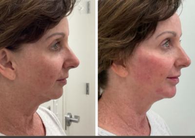 Lower face filler at REN Dermatology