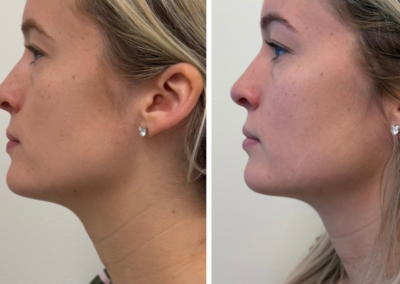 Chin and jawline filler at REN Dermatology